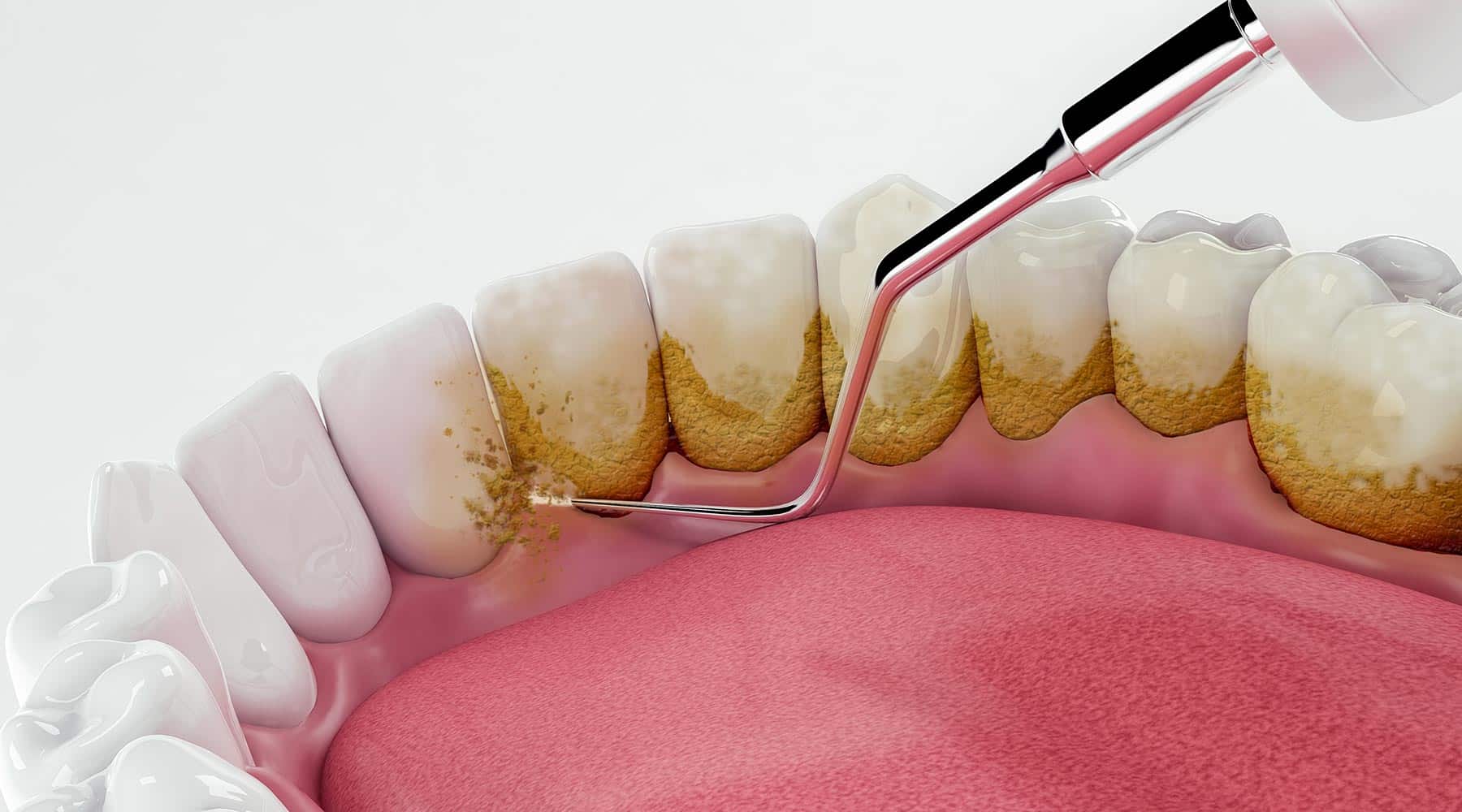 Importance of Regular Teeth Cleaning