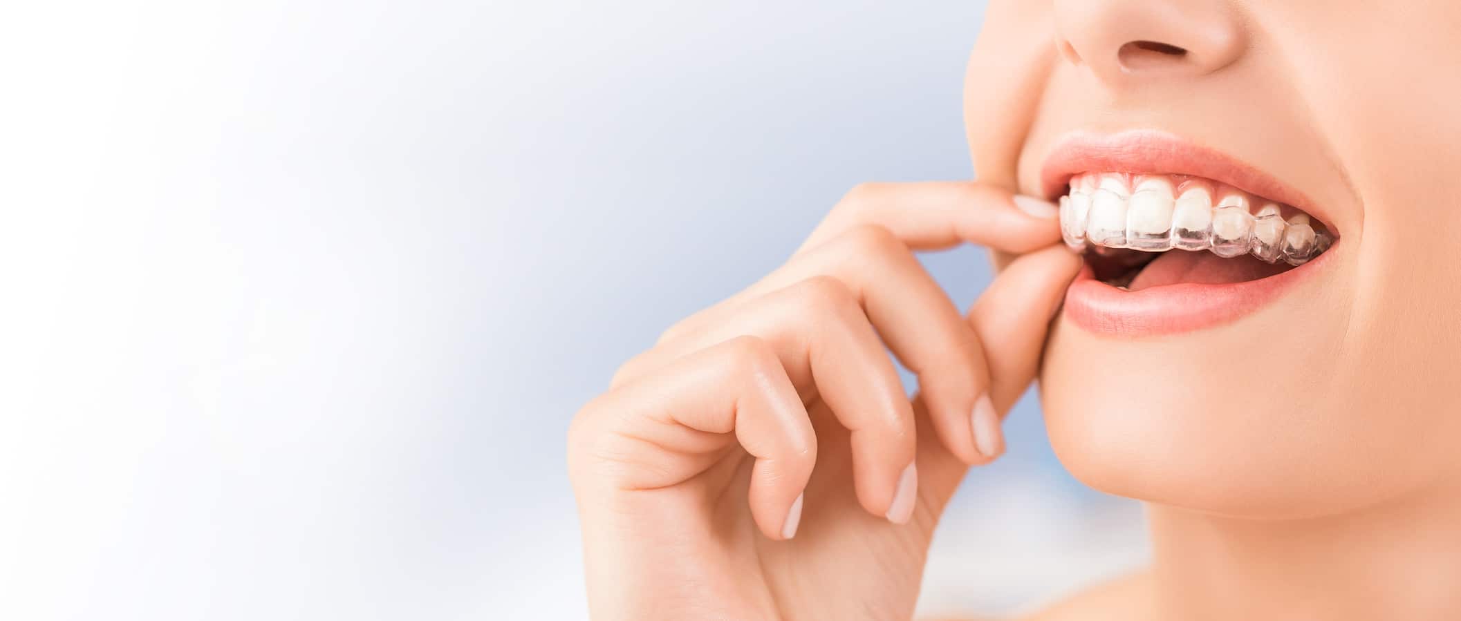 How Long Does Invisalign Take to Straighten Teeth? A Complete Timeline