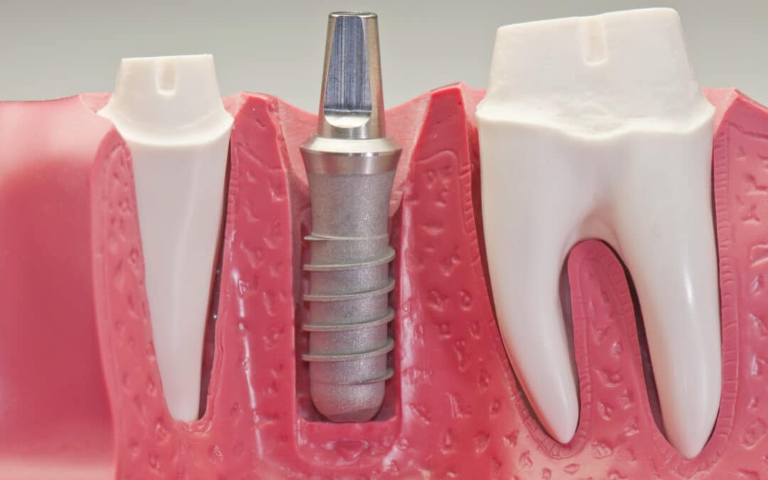 5 Reasons Why Dental Implants Could Be the Perfect Choice for Your Smile