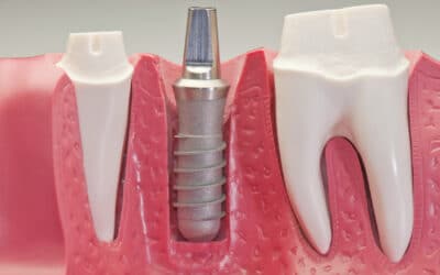 5 Reasons Why Dental Implants Could Be the Perfect Choice for Your Smile