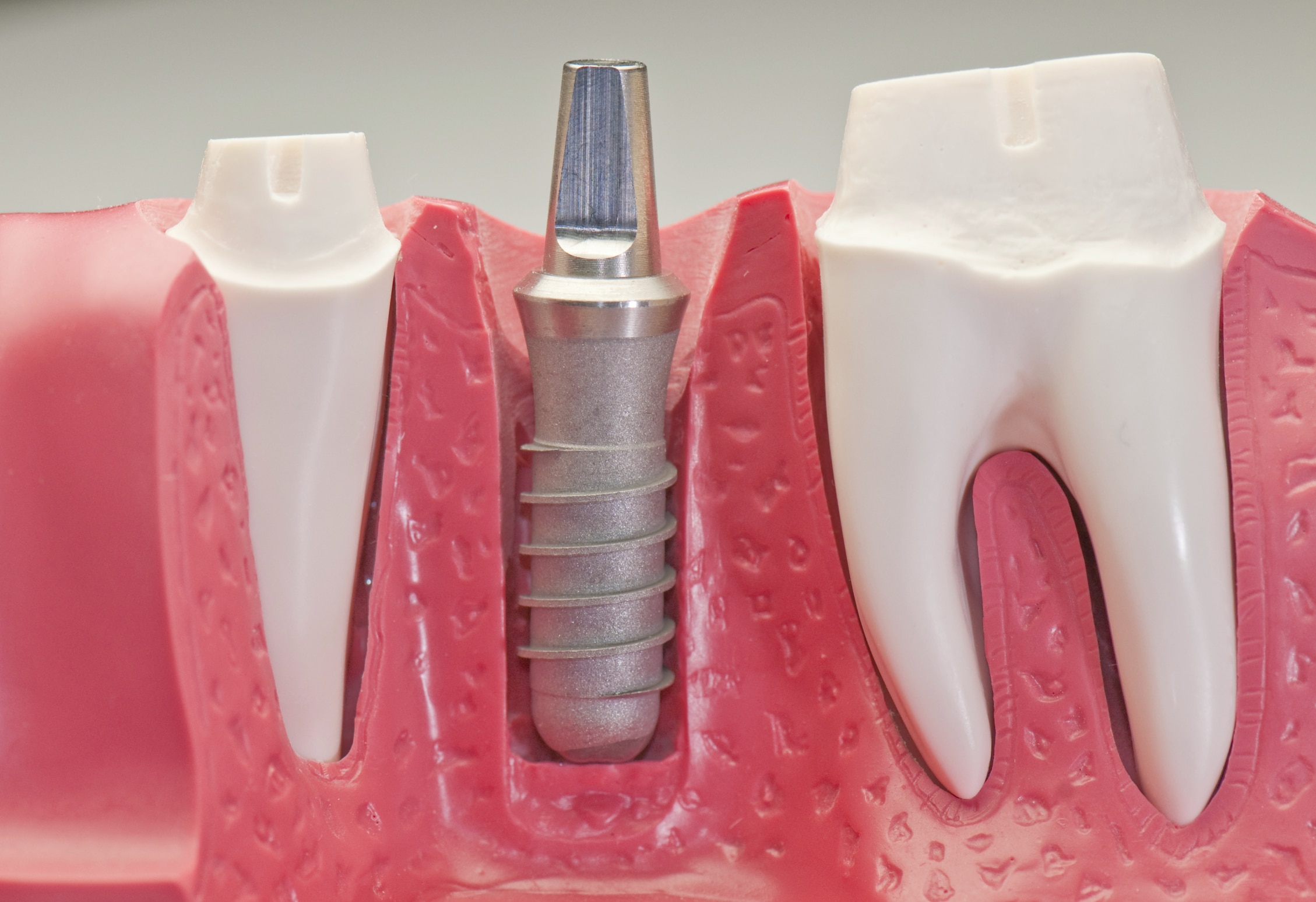 dental implant model